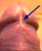Example of a frenulum